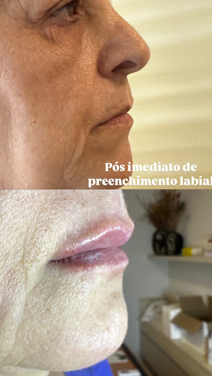 Preenchimento Labial