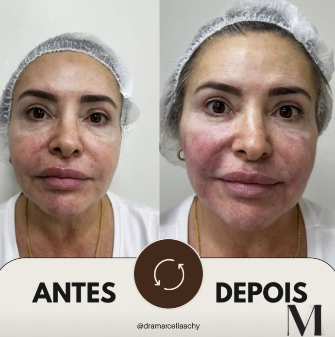 Preenchimento de Olheiras