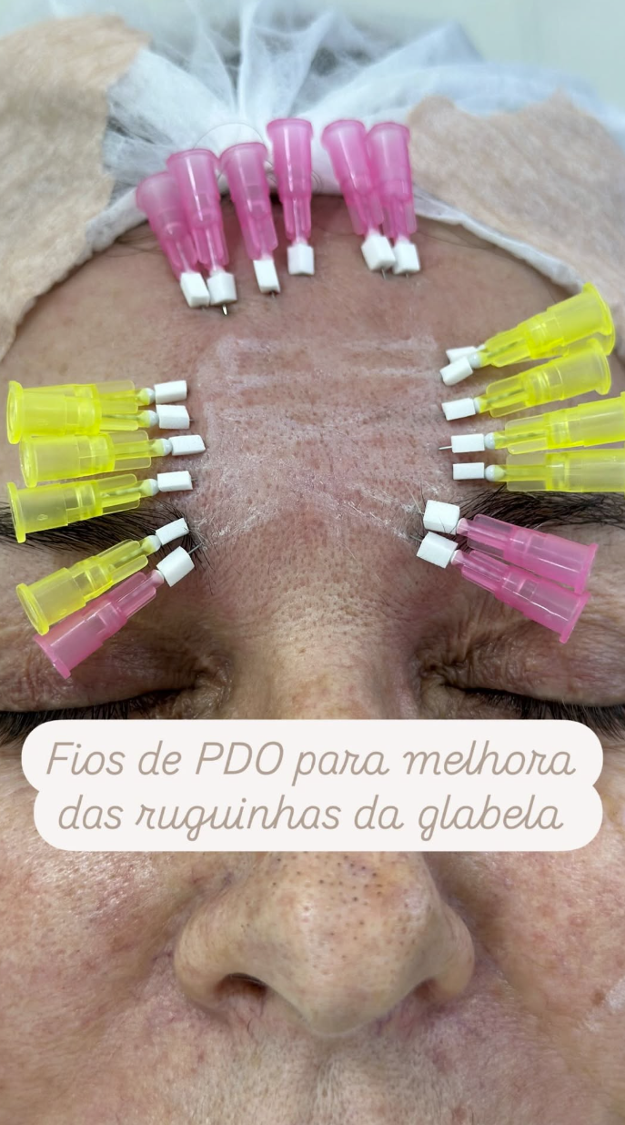 Fios de PDO