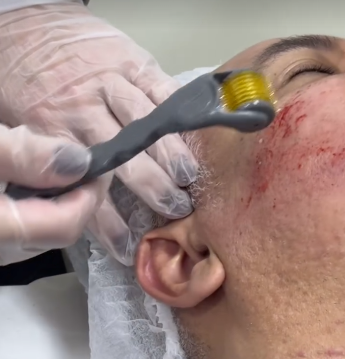 Tratamentos para melasma e cicatriz de acne